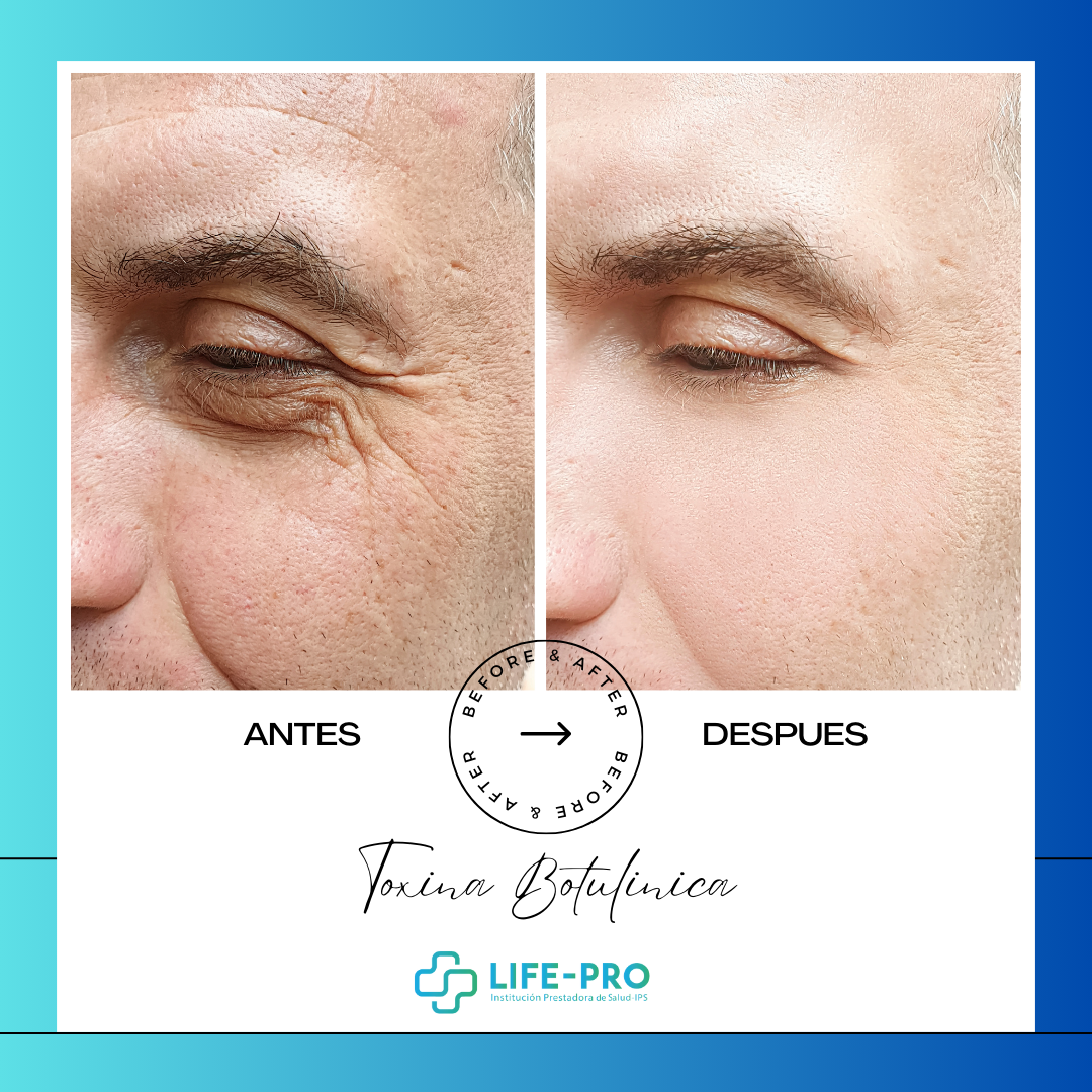 Toxina Botulínica - Rejuvenecimiento Facial - Life-Pro