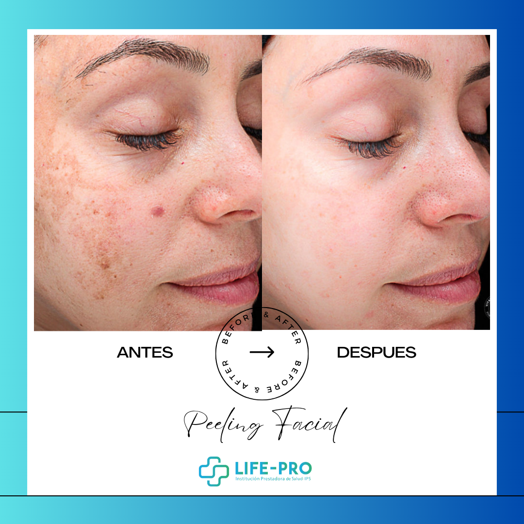 Peelings – Para quitar manchas & imperfecciones del rostro. - Life-Pro