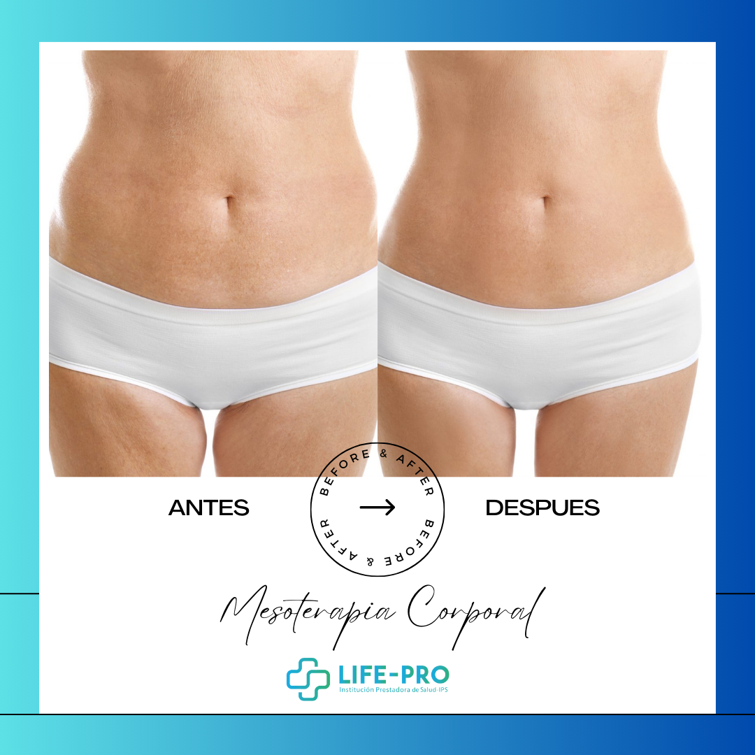 Mesoterapia Corporal - Life-Pro